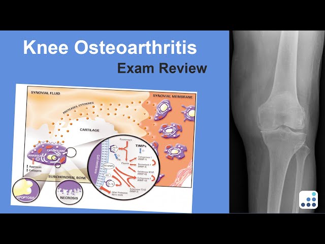 Knee Osteoarthritis Exam Review - Mark Pagnano, MD