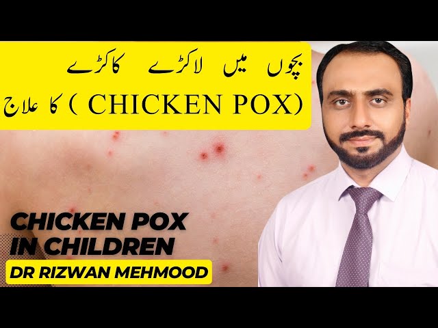 Chicken Pox in children | Lakra Kakra in ChildrenDr Rizwan Mehmood,Child Specialist