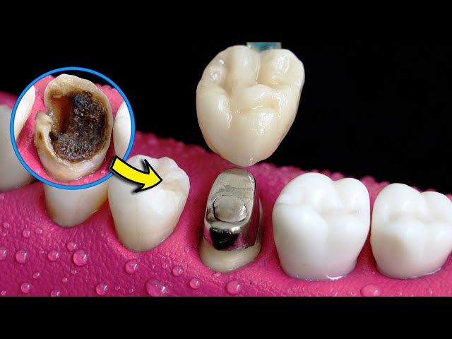 Dentist Restoring The Hopeless Tooth By The Amazing Post And Core Treatment.