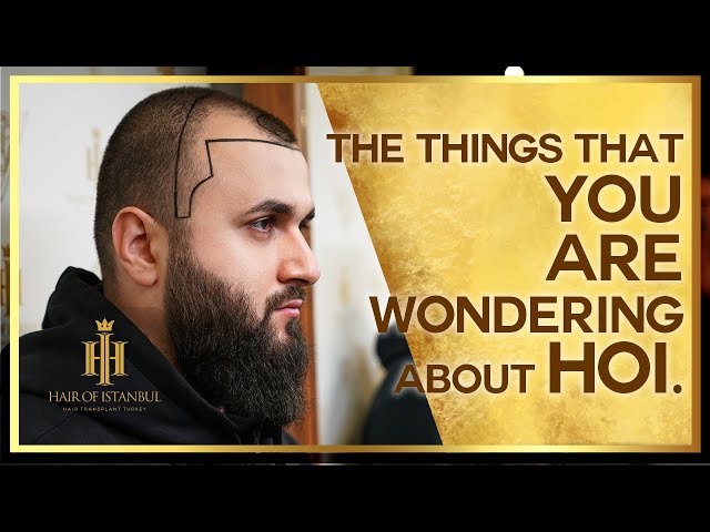 The Things That You  Are Wondering About HOI #hairtransplantation