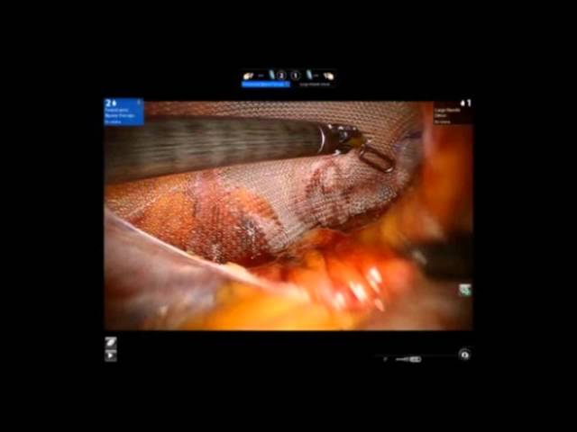 Dr. Iraniha Operating Robotic Inguinal Hernia Repair