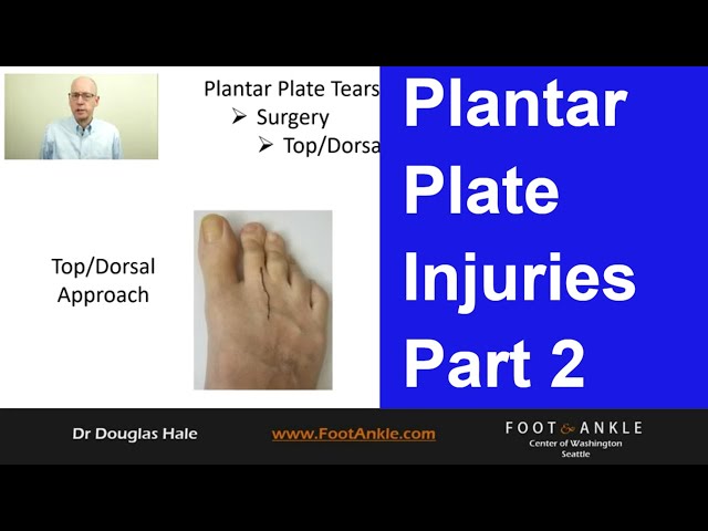 Plantar Plate Injuries - Part 2 | Seattle Podiatrist