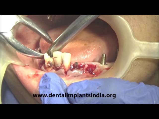 Lower jaw -ALL TEETH EXTRACTION AND IMMEDIATE IMPLANTATION -FULL SURGERY VIDEO