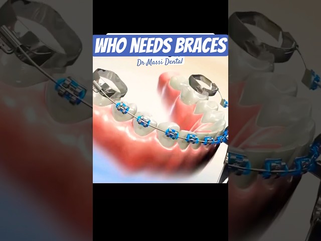 Are you getting Braces OFF soon excited?