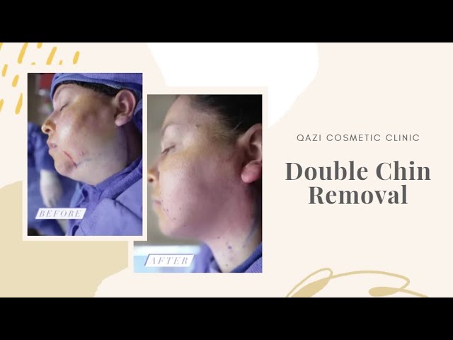 DOUBLE CHIN REMOVAL