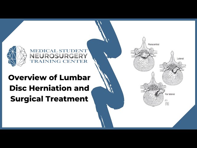 Overview of Lumbar Disc Herniation and Surgical Treatment