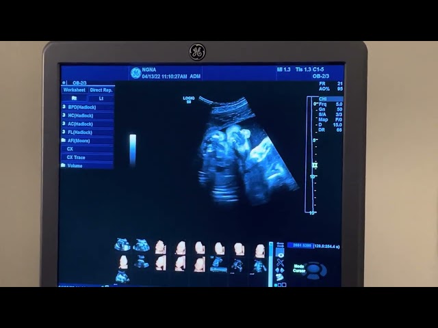 Ultrasound