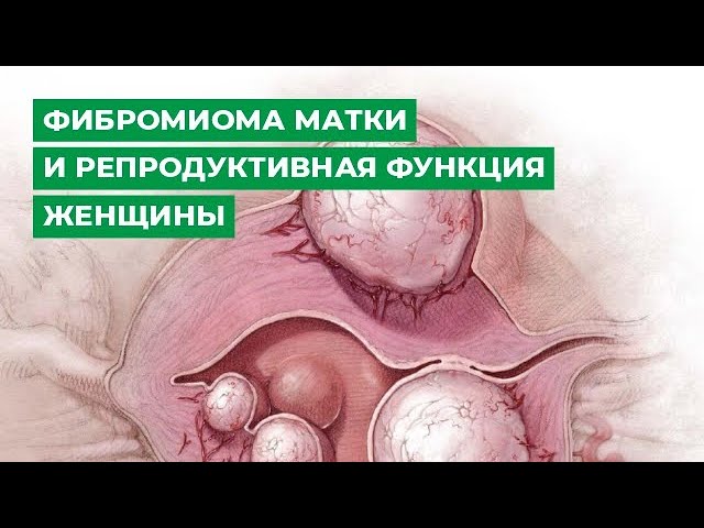 Фибромиома матки и репродуктивная функция женщины