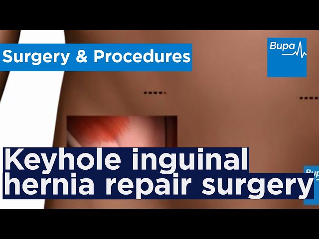 How keyhole inguinal hernia repair surgery is carried out | Bupa Health