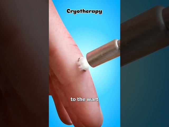 How Cryotherapy Removes a Blister | Animated Explainer!