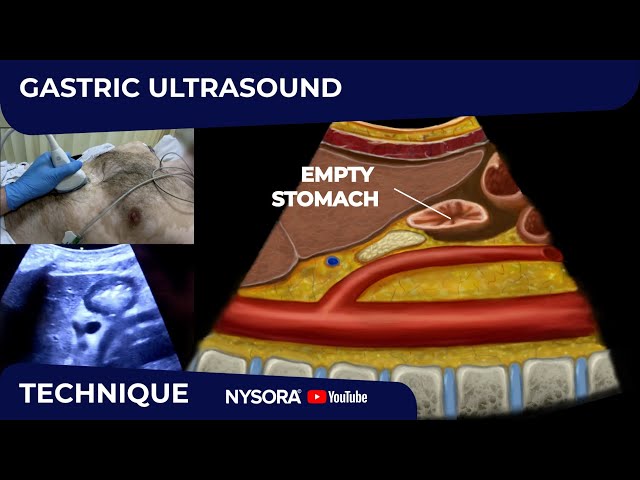 HOW TO: GASTRIC ULTRASOUND