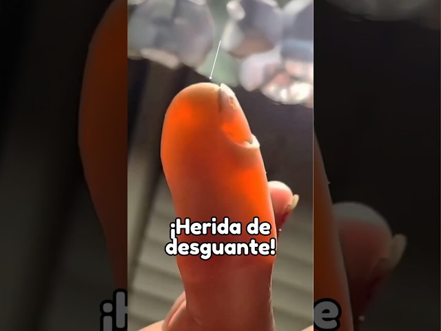 Que es lo que hay en el #dedo de este hombre? - Doctores Especialistas