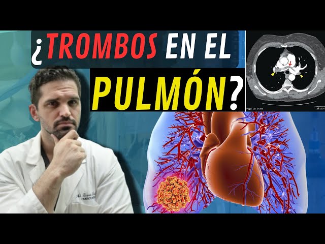 ¡MIRA¡ la Trombosis (Coágulos) Pulmonar: Causas, Síntomas y Tratamientos ⚠