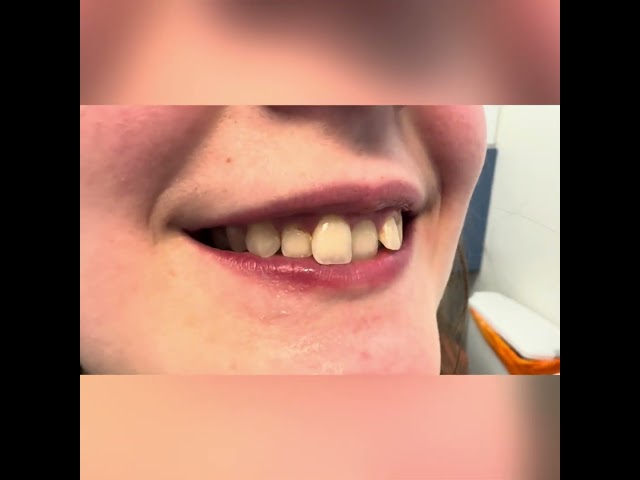 Teeth straightening before/after