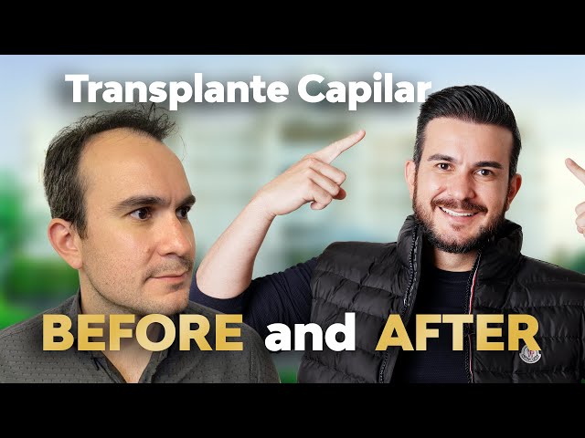 Olício’s Hair Transplant Before and After | Result After 2 Years