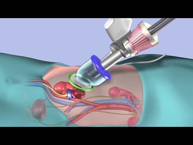 Cleveland Clinic's First in the World to Perform Robotic Single-Port Kidney Transplant