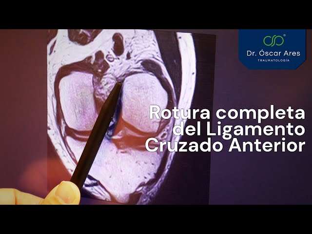 Rotura completa del Ligamento Cruzado Anterior - Dr. Oscar Ares