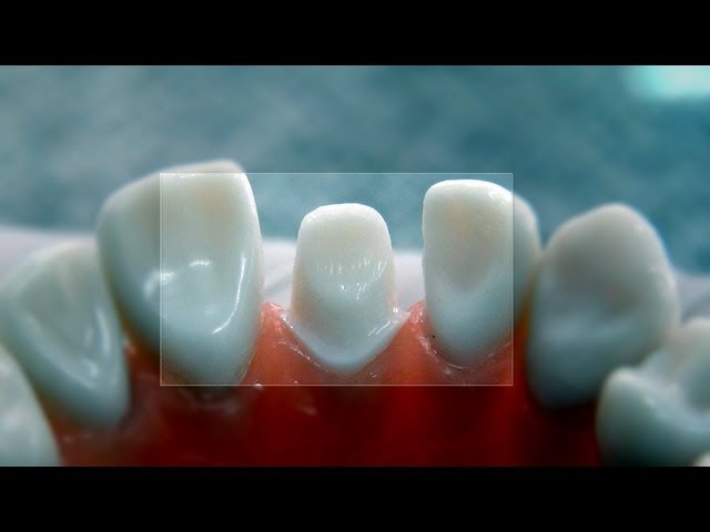 All ceramic crown "tooth preparation" - for dental students