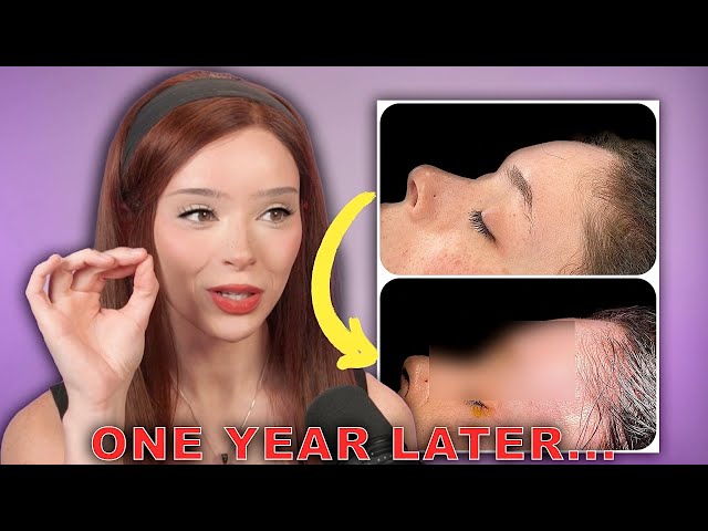 1 Year Facial Feminization Surgery Update! (Sensation, Scarring, Hair Regrowth, +more)