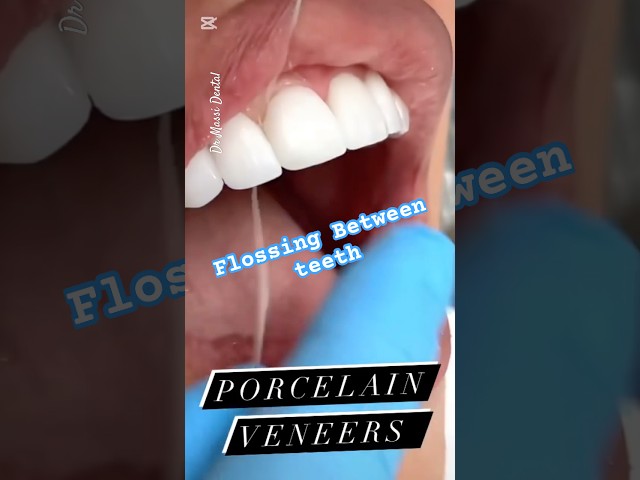 Flossing Between Teeth Veneers