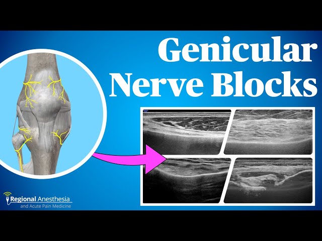 Ultrasound Guided Genicular Blocks (2024 update!)