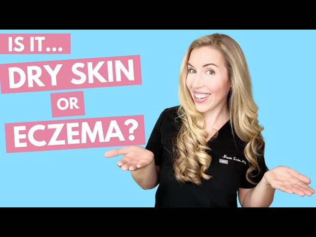 Is it Dry Skin or Eczema? | How to Treat With Affordable Product Recommendations!