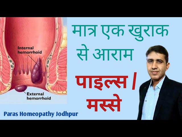 मस्से | पाइल्स | बवासीर का परमानेंट इलाज | Best Homeopathic Medicine For piles | Piles Treatment