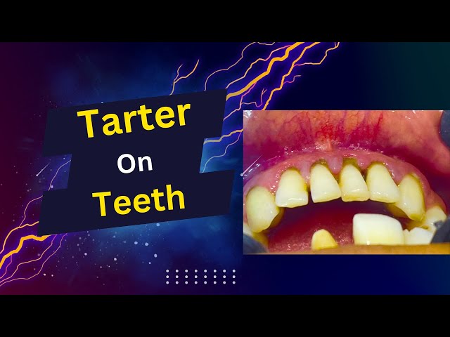 Get Rid of Tarter On Teeth in Just 5 Minutes a Day!