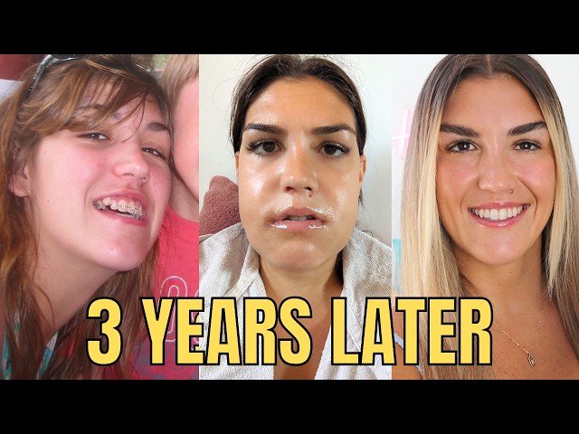 Do I Regret My Double Jaw Surgery? My Honest Experience with Recovery and My Results