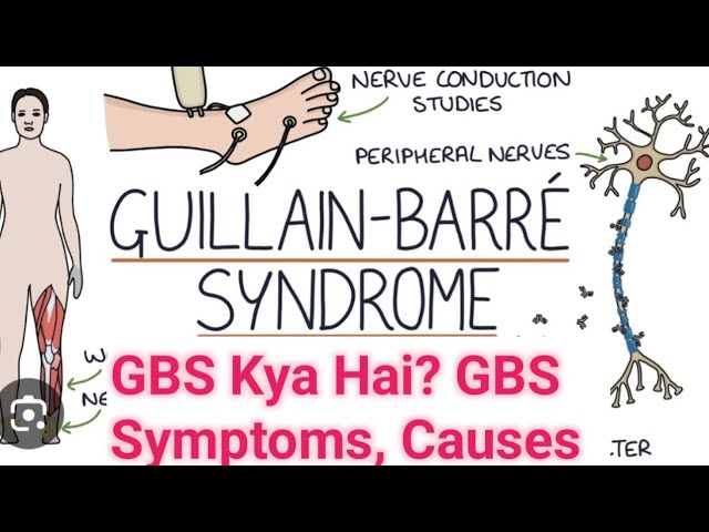 Guillain Barre Syndrome Kya Hai? GBS Symptoms, Causes | Kya Karna Chahiye?