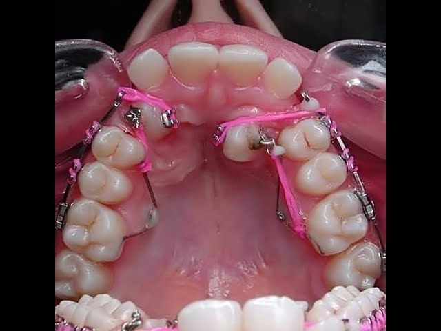 Kéo răng nanh mọc ngầm bằng niềng răng (orthodontic)