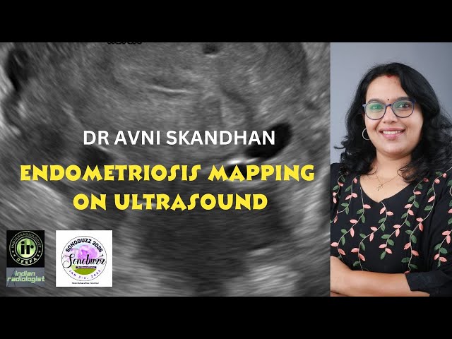 AVNI SKANDHAN | ENDOMETRIOSIS MAPPING by Ultrasound #endometriosis