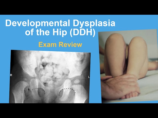 Developmental Dysplasia of the Hip Exam Review - Ernie Sink, MD