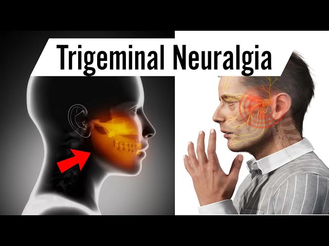 Trigeminal Neuralgia: Symptoms, Causes, Treatments in hindi