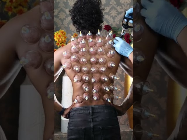 அருவியாய் கொட்டும் குடுவை சிகிச்சை அருணின் முதுகில் இருந்து #cupping #cuppingtherapy #chennai #face