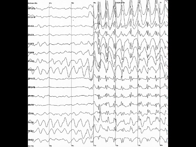 Epilepsy | Wikipedia audio article