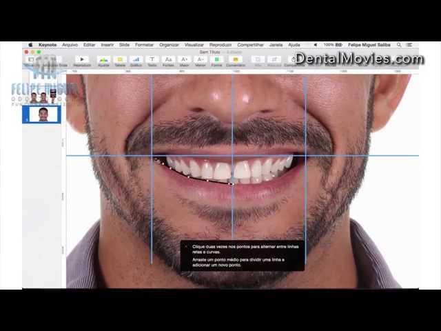 DSD - Digital Smile Design by Felipe Miguel