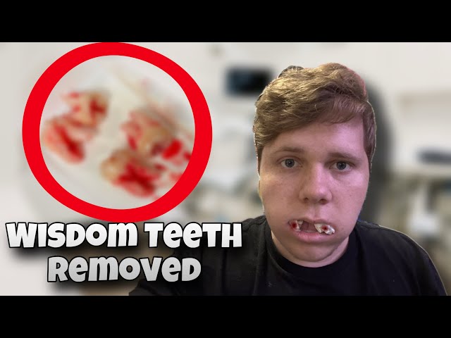 I Got My WISDOM TEETH Removed!