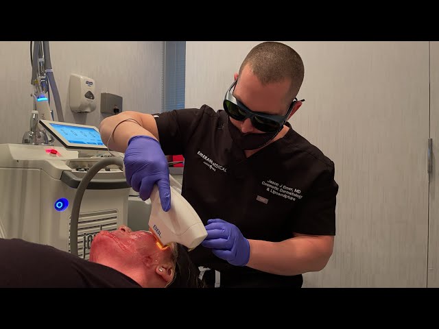 MY SKIN WAS BURNED AND SCITON BBL HERO, FRAXEL LASER, SKINPEN PRP IMPROVED SKIN | NYC DR JASON EMER