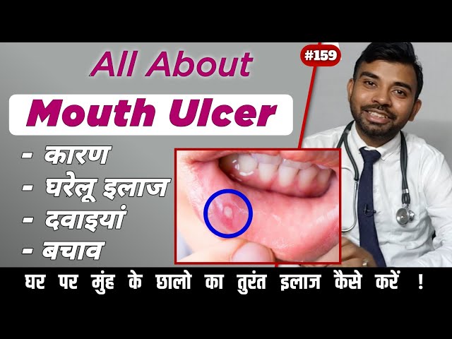 मुंह के छालों (Mouth Ulcers) का इलाज | mouth Ulcer treatment | muh ke chhale kaise thik kare