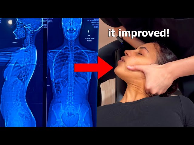 ASMR: Chiropractor Adjusts my Scoliosis with Neck and Back Cracks!