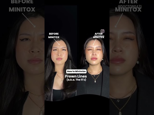 MINTOX BEFORE + AFTER RESULTS 🔥 (COMPARABLE TO BOTOX)