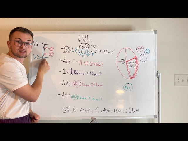 EKG Series: Left Ventricular Hypertrophy Criteria