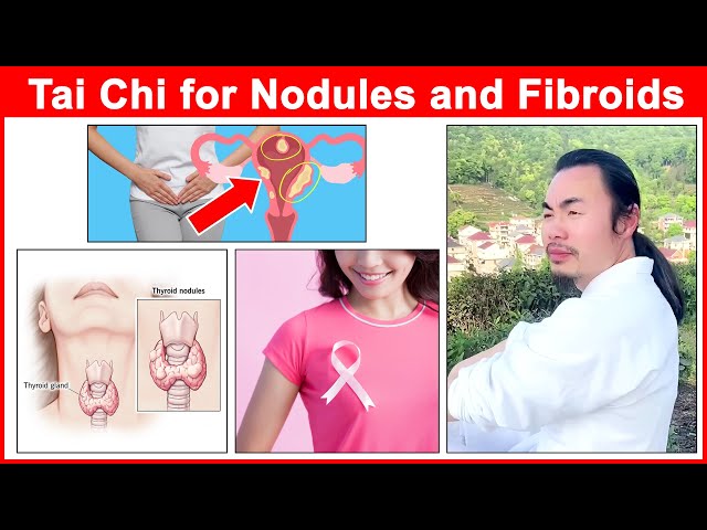 Tai Chi for Thyroid Nodules, Breast Nodules and Uterine Fibroids -  Taichi Zidong