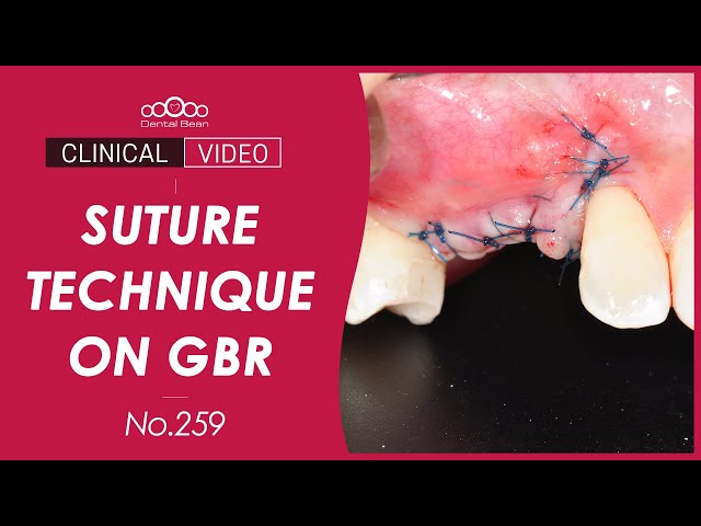 Suture technique on GBR - [Dr. Kim Jaeyoon]