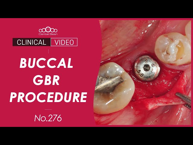 Simple buccal GBR with membrane punch [Dr. Kim Jaeyoon]