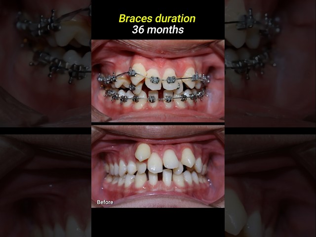 Braces for crowded teeth #braces #orthodontist #dentistry #dentist