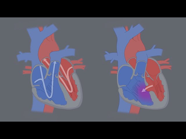 Congenital Heart Defects - What is a CHD?