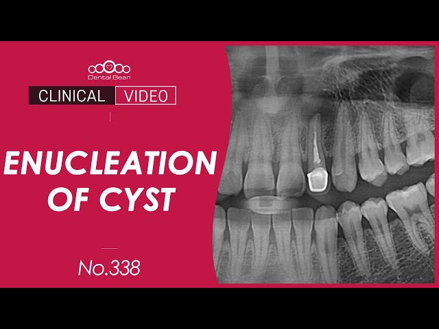 Enucleation of cyst with bone graft [Dr. Kim Yongjin]