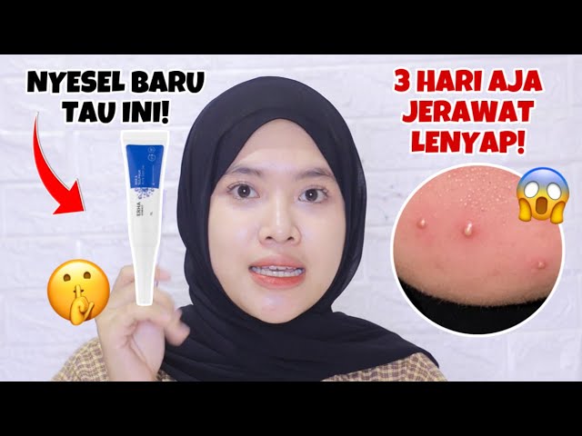 JERAWAT DAN BEKASNYA HILANG DALAM 3 HARI! ERHA ACNEACT ACNE SPOT GEL ✨ | indrimeiliana